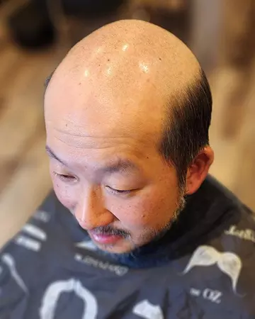01 mens hair restoration systems before and after photo 02 solutions before after mens gallery hair restoration systems 01 mens hair restoration systems before and after photo 02