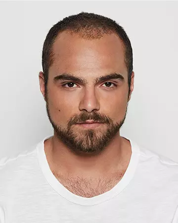 02 mens hair restoration systems before and after photo 02 solutions before after mens gallery hair restoration systems 02 mens hair restoration systems before and after photo 02