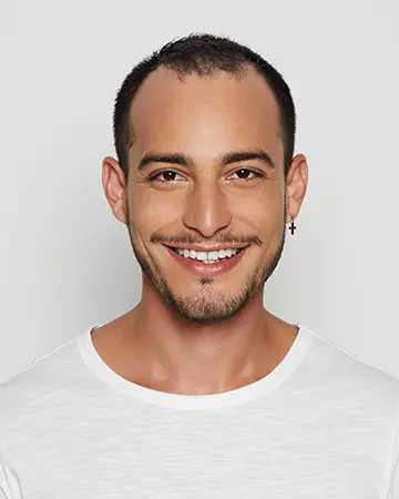 03 mens hair restoration systems before and after photo 02 solutions before after mens gallery hair restoration systems 03 mens hair restoration systems before and after photo 02
