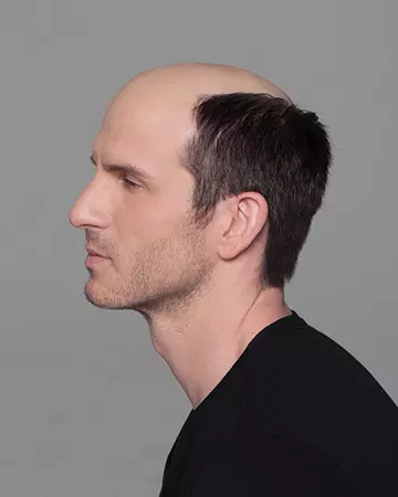 04 mens hair restoration systems before and after photo 02 solutions before after mens gallery hair restoration systems 04 mens hair restoration systems before and after photo 02