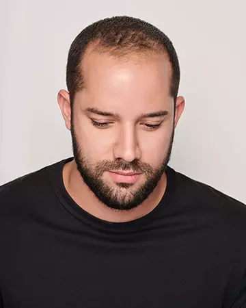 06 mens hair restoration systems before and after photo 02 solutions before after mens gallery hair restoration systems 06 mens hair restoration systems before and after photo 02