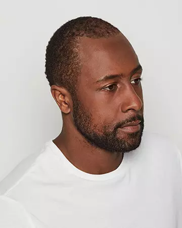 08 mens hair restoration systems before and after photo 02 solutions before after mens gallery hair restoration systems 08 mens hair restoration systems before and after photo 02