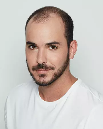 09 mens hair restoration systems before and after photo 02 solutions before after mens gallery hair restoration systems 09 mens hair restoration systems before and after photo 02