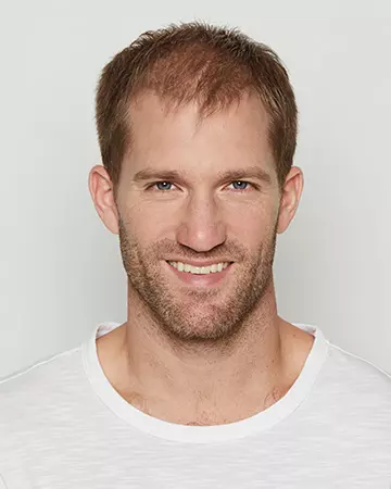 11 mens hair restoration systems before and after photo 02 solutions before after mens gallery hair restoration systems 11 mens hair restoration systems before and after photo 02