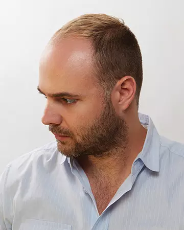 12 mens hair restoration systems before and after photo 02 solutions before after mens gallery hair restoration systems 12 mens hair restoration systems before and after photo 02