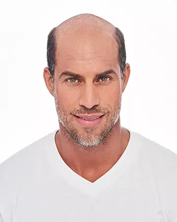 13 mens hair restoration systems before and after photo 02 solutions before after mens gallery hair restoration systems 13 mens hair restoration systems before and after photo 02
