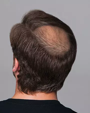 14 mens hair restoration systems before and after photo 02 solutions before after mens gallery hair restoration systems 14 mens hair restoration systems before and after photo 02