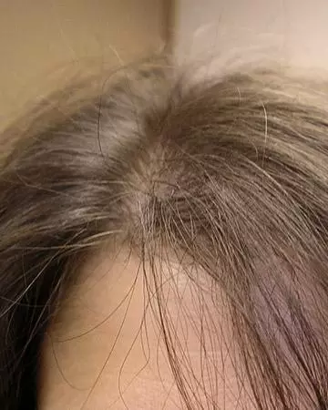 01 hair regrowth products before and after photo 01 solutions before after neutral gallery hair regrowth products 01 hair regrowth products before and after photo 01