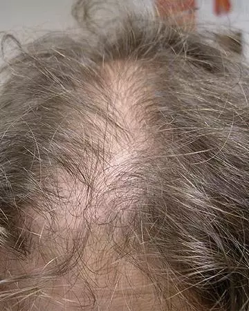 01 hair regrowth products before and after photo 02 solutions before after neutral gallery hair regrowth products 01 hair regrowth products before and after photo 02