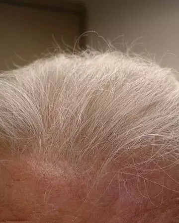 02 hair regrowth products before and after photo 01 solutions before after neutral gallery hair regrowth products 02 hair regrowth products before and after photo 01