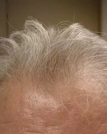 02 hair regrowth products before and after photo 02 solutions before after neutral gallery hair regrowth products 02 hair regrowth products before and after photo 02