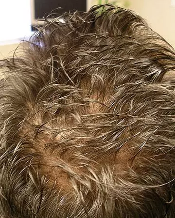 03 hair regrowth products before and after photo 01 solutions before after neutral gallery hair regrowth products 03 hair regrowth products before and after photo 01