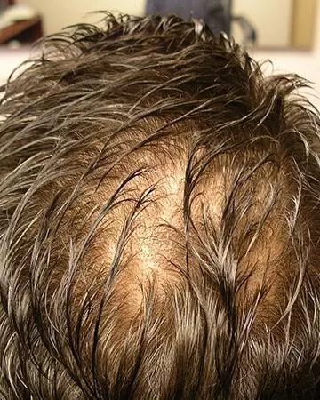 03 hair regrowth products before and after photo 02 solutions before after neutral gallery hair regrowth products 03 hair regrowth products before and after photo 02