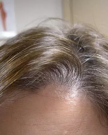 04 hair regrowth products before and after photo 01 solutions before after neutral gallery hair regrowth products 04 hair regrowth products before and after photo 01