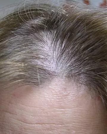 04 hair regrowth products before and after photo 02 solutions before after neutral gallery hair regrowth products 04 hair regrowth products before and after photo 02