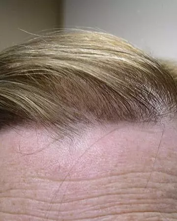 05 hair regrowth products before and after photo 01 solutions before after neutral gallery hair regrowth products 05 hair regrowth products before and after photo 01
