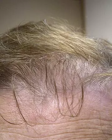 05 hair regrowth products before and after photo 02 solutions before after neutral gallery hair regrowth products 05 hair regrowth products before and after photo 02
