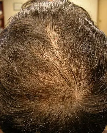 06 hair regrowth products before and after photo 01 solutions before after neutral gallery hair regrowth products 06 hair regrowth products before and after photo 01
