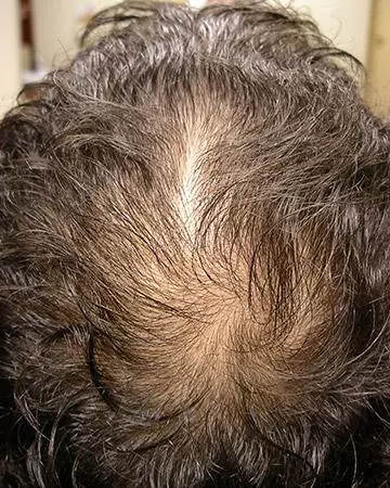 06 hair regrowth products before and after photo 02 solutions before after neutral gallery hair regrowth products 06 hair regrowth products before and after photo 02