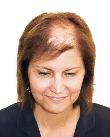   solutions before after womens gallery hair restoration systems 07 hair restoration systems before and after photo 02