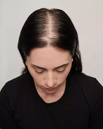 05 wigs before and after photo 02 solutions before after womens gallery wigs 05 wigs before and after photo 02